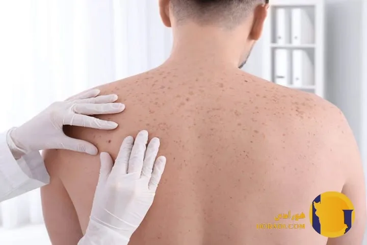 علائم اولیه سرطان پوست و تشخیص آن