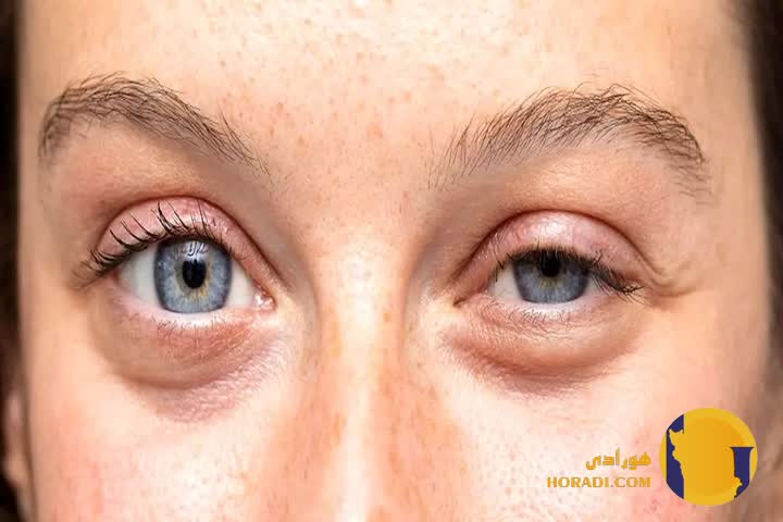 راهکارهای طبیعی برای درمان افتادگی پلک
