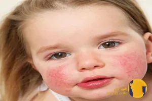 آلرژی غذایی چیست؟ علائم غذاهای حساسیت زا و درمان