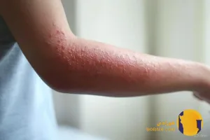 حساسیت پوستی (Skin Allergy) یکی از شایع ترین مشکلات پوستی است که می تواند کیفیت زندگی افراد را به شدت تحت تأثیر قرار دهد.