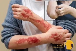 حساسیت پوستی (Skin Allergy) یکی از شایع ترین مشکلات پوستی است که می تواند کیفیت زندگی افراد را به شدت تحت تأثیر قرار دهد.