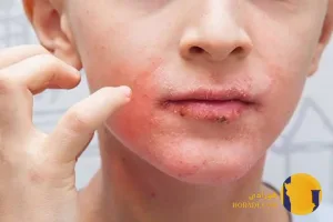 اگزما چیست؟ علائم علت ها و روش های کاهش التهاب