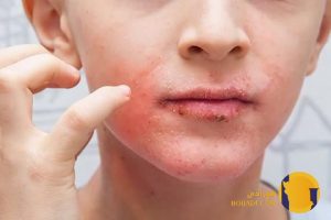 اگزما چیست؟ علائم علت ها و روش های کاهش التهاب
