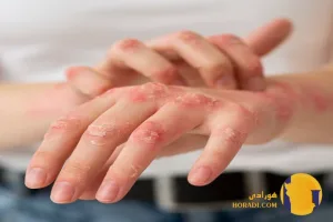 اگزما چیست؟ علائم علت ها و روش های کاهش التهاب