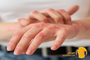 اگزما چیست؟ علائم علت ها و روش های کاهش التهاب