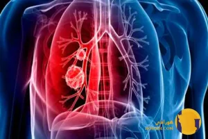 برونشیت چیست؟ علائم تشخیص و درمان خانگی