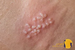 سوزاک در مردان چیست؟ علائم عوارض و روش های درمان