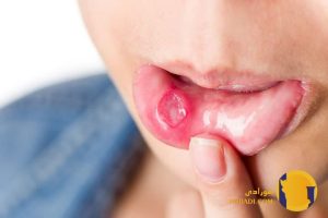 سوزاک در زنان چیست؟ علائم تشخیص و درمان