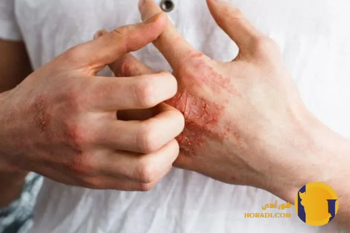 سوزاک در زنان چیست؟ علائم تشخیص و درمان