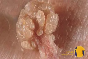 HIV چیست؟ علائم اولیه راه های انتقال و درمان