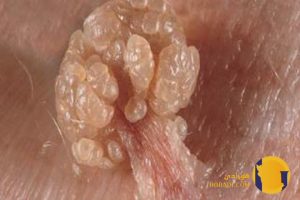 HIV چیست؟ علائم اولیه راه های انتقال و درمان