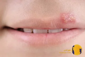 تبخال چیست؟ علائم انواع و روش های درمان