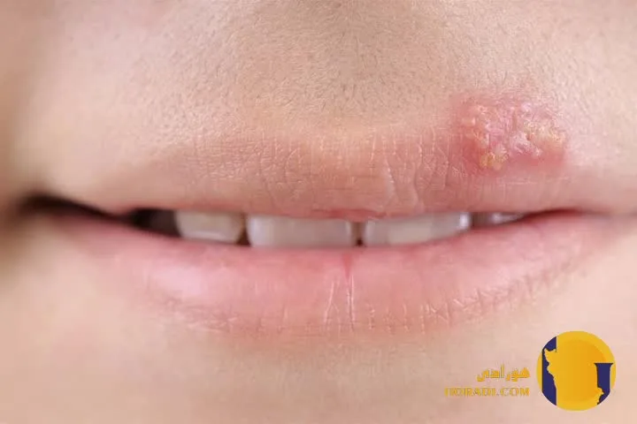 تبخال چیست؟ علائم انواع و روش های درمان