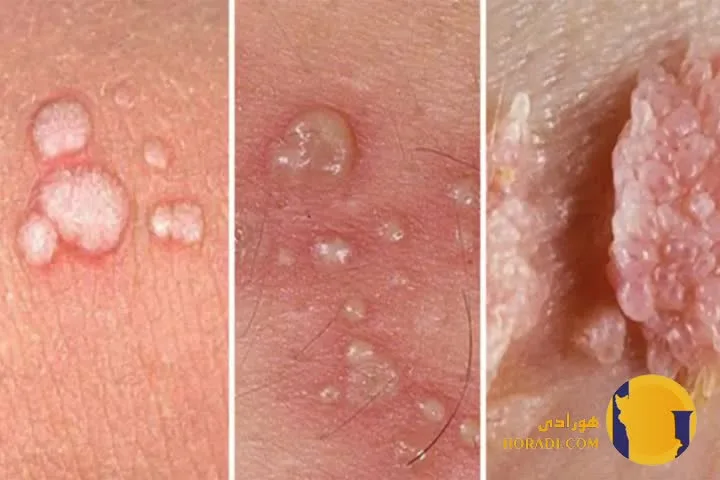 زگیل تناسلی چیست؟ علائم علت ها و درمان