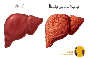 هپاتیت B چیست؟ علائم انتقال و درمان