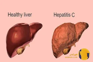 هپاتیت C چیست؟ علائم تشخیص و درمان