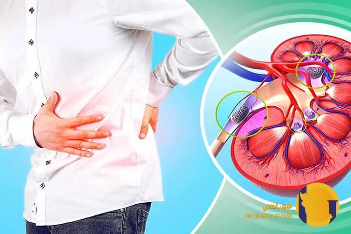 سنگ کلیه چیست؟ علائم علت ها و درمان