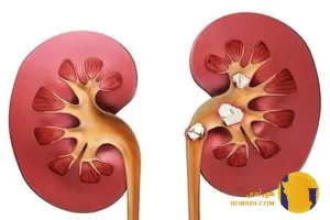 سنگ کلیه چیست؟ علائم علت ها و درمان