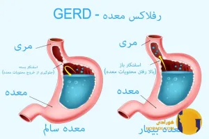 رفلاکس معده چیست؟ علائم علت ها و روش های کنترل