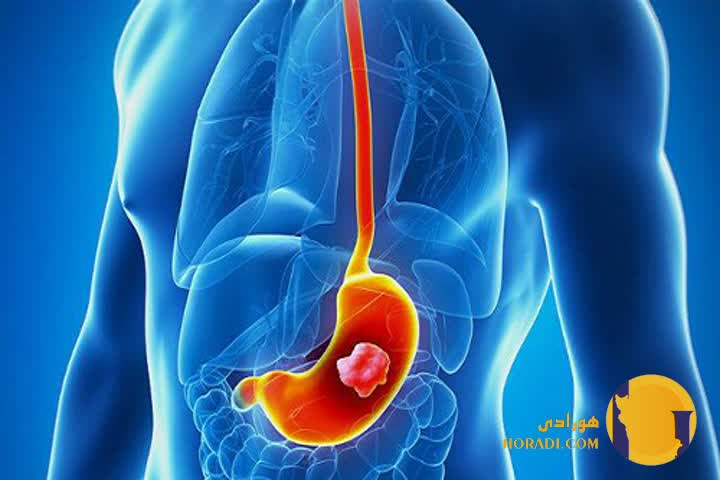 سوء هاضمه چیست؟ علائم علت ها و درمان خانگی