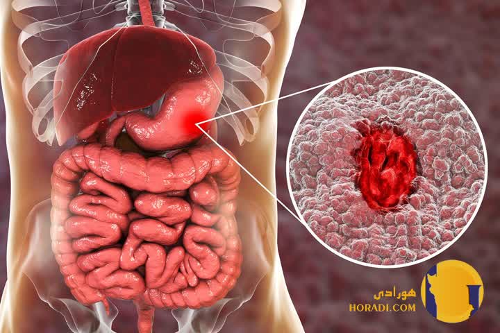 زخم معده چیست؟ علائم علت ها و روش های درمان