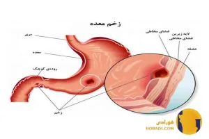 زخم معده چیست؟ علائم علت ها و روش های درمان