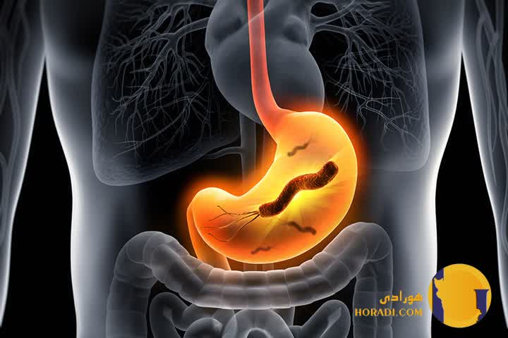 هلیکوباکتر پیلوری چیست؟ علائم تشخیص و درمان