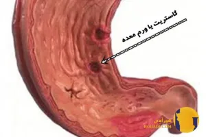 التهاب معده چیست؟ علائم علت ها و روش های کاهش درد