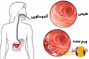 التهاب معده چیست؟ علائم علت ها و روش های کاهش درد