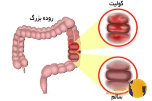 کولیت چیست؟ علائم انواع و درمان