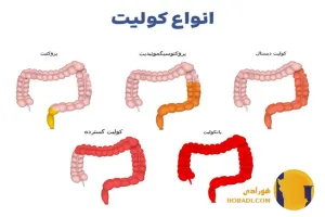 کولیت چیست؟ علائم انواع و درمان