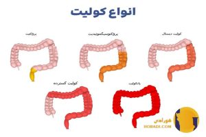 کولیت چیست؟ علائم انواع و درمان
