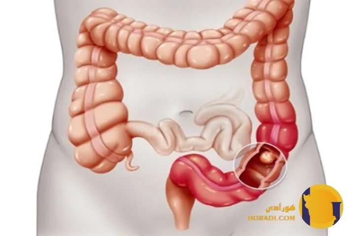 کرون چیست؟ علائم عوارض و درمان