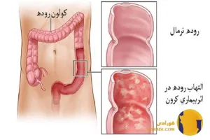 کرون چیست؟ علائم عوارض و درمان