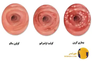 کرون چیست؟ علائم عوارض و درمان