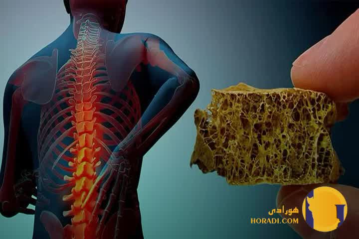 پوکی استخوان چیست؟ علائم عوامل خطر و پیشگیری