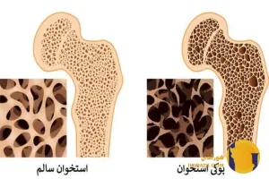 پوکی استخوان چیست؟ علائم عوامل خطر و پیشگیری