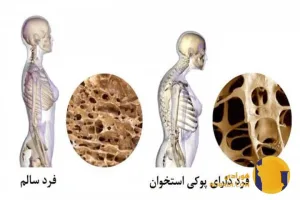 پوکی استخوان چیست؟ علائم عوامل خطر و پیشگیری