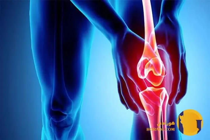 آرتروز چیست؟ علائم علت ها و روش های درمان