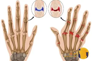 آرتریت روماتوئید
