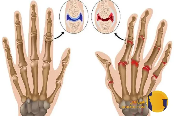آرتریت روماتوئید