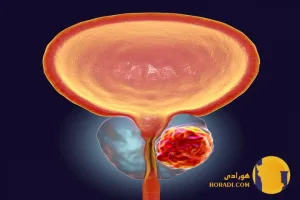 سرطان پروستات چیست؟ علائم تشخیص و درمان