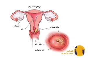 سرطان دهانه رحم چیست؟ علائم تشخیص و درمان