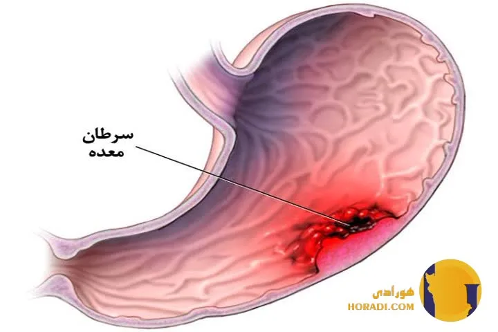 سرطان معده چیست؟ علائم تشخیص و درمان