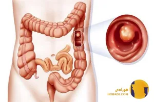سرطان روده چیست؟ علائم علت ها و درمان
