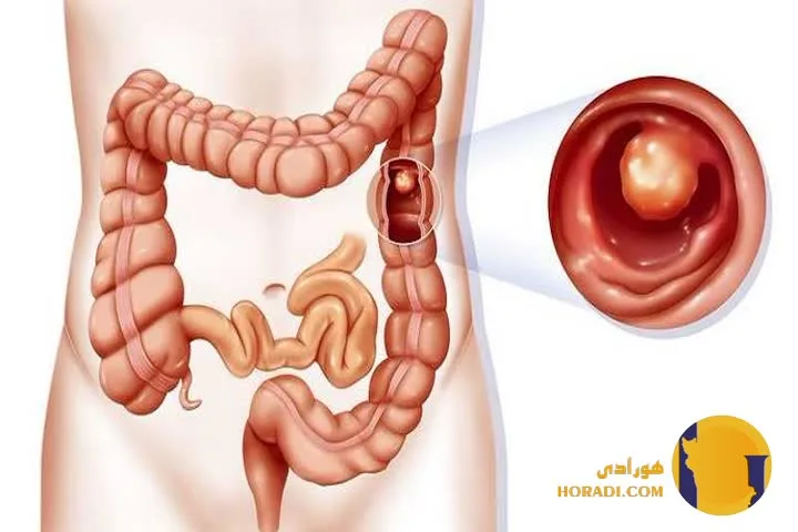 سرطان روده چیست؟ علائم علت ها و درمان