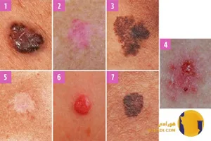 سرطان پوست چیست؟ علائم و روش های پیشگیری