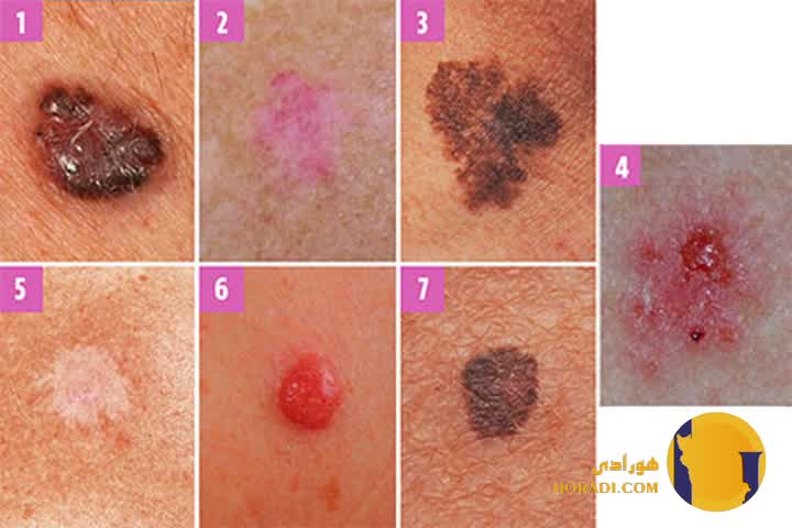 سرطان پوست چیست؟ علائم و روش های پیشگیری