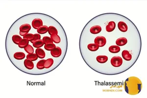 تالاسمی چیست؟ علائم تشخیص و درمان