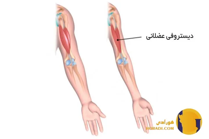 دیستروفی عضلانی چیست؟ علائم تشخیص و درمان